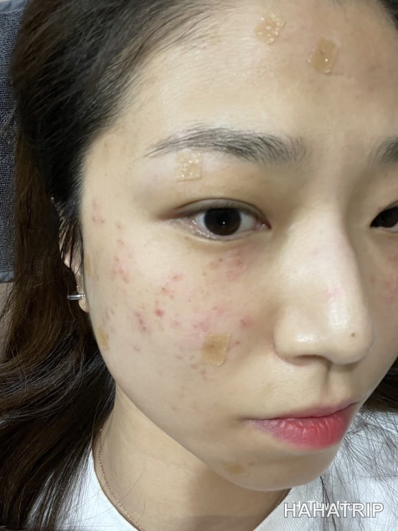 피부 잡티 제거 관련 사진 - HAHATRIP 여행 가이드 피부 잡티 제거 이미지 10 - HAHATRIP
