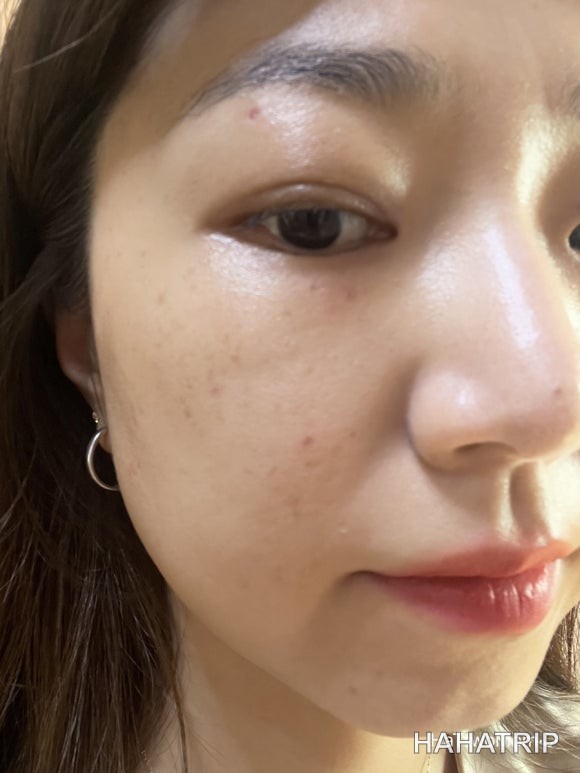 피부 잡티 제거 관련 사진 - HAHATRIP 여행 가이드 피부 잡티 제거 이미지 12 - HAHATRIP