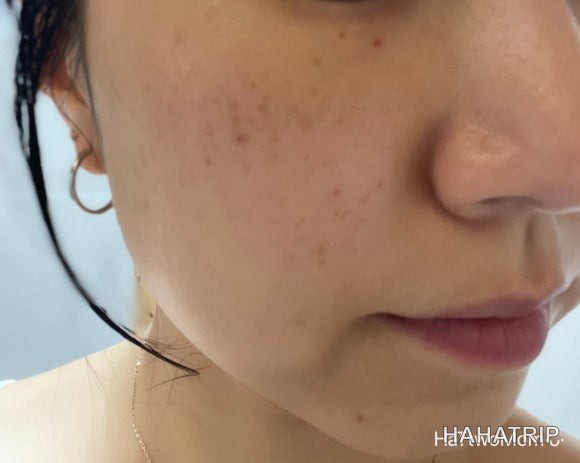 피부 잡티 제거 관련 사진 - HAHATRIP 여행 가이드 피부 잡티 제거 이미지 15 - HAHATRIP