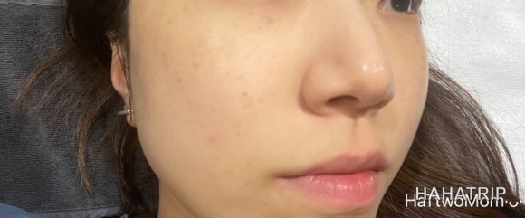 피부 잡티 제거 관련 사진 - HAHATRIP 여행 가이드 피부 잡티 제거 이미지 24 - HAHATRIP