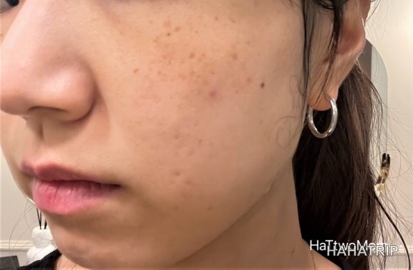 피부 잡티 제거 관련 사진 - HAHATRIP 여행 가이드 피부 잡티 제거 이미지 2 - HAHATRIP
