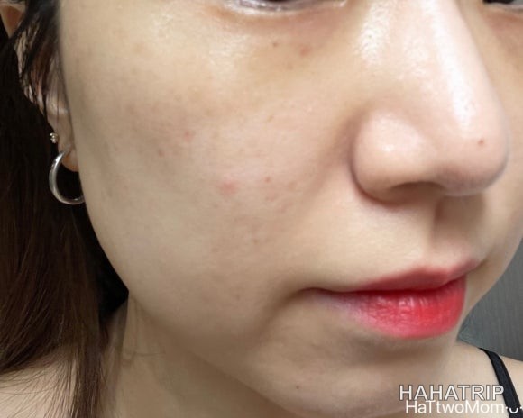 피부 잡티 제거 관련 사진 - HAHATRIP 여행 가이드 피부 잡티 제거 이미지 33 - HAHATRIP