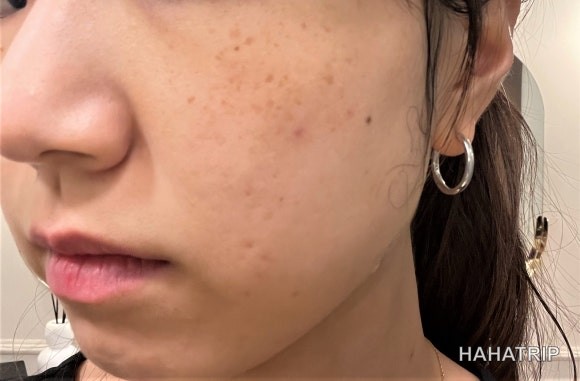 피부 잡티 제거 관련 사진 - HAHATRIP 여행 가이드 피부 잡티 제거 이미지 34 - HAHATRIP